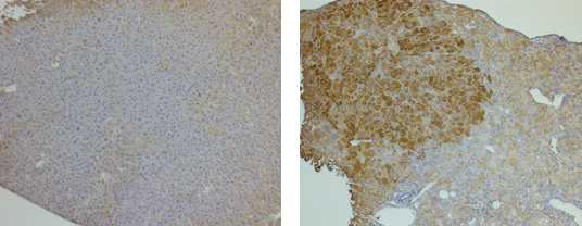 Familial tyrosinemia type I 질병모델을 교정하였을 때 정상적인 FAH 유전자의 발현을 IHC를 통해 확인함. 왼쪽이 치료 전 FAH 발현이 없는 상태이고, 오른쪽이 치료 후 일부 간세포에서 FAH 발현(갈색으로 염색)됨