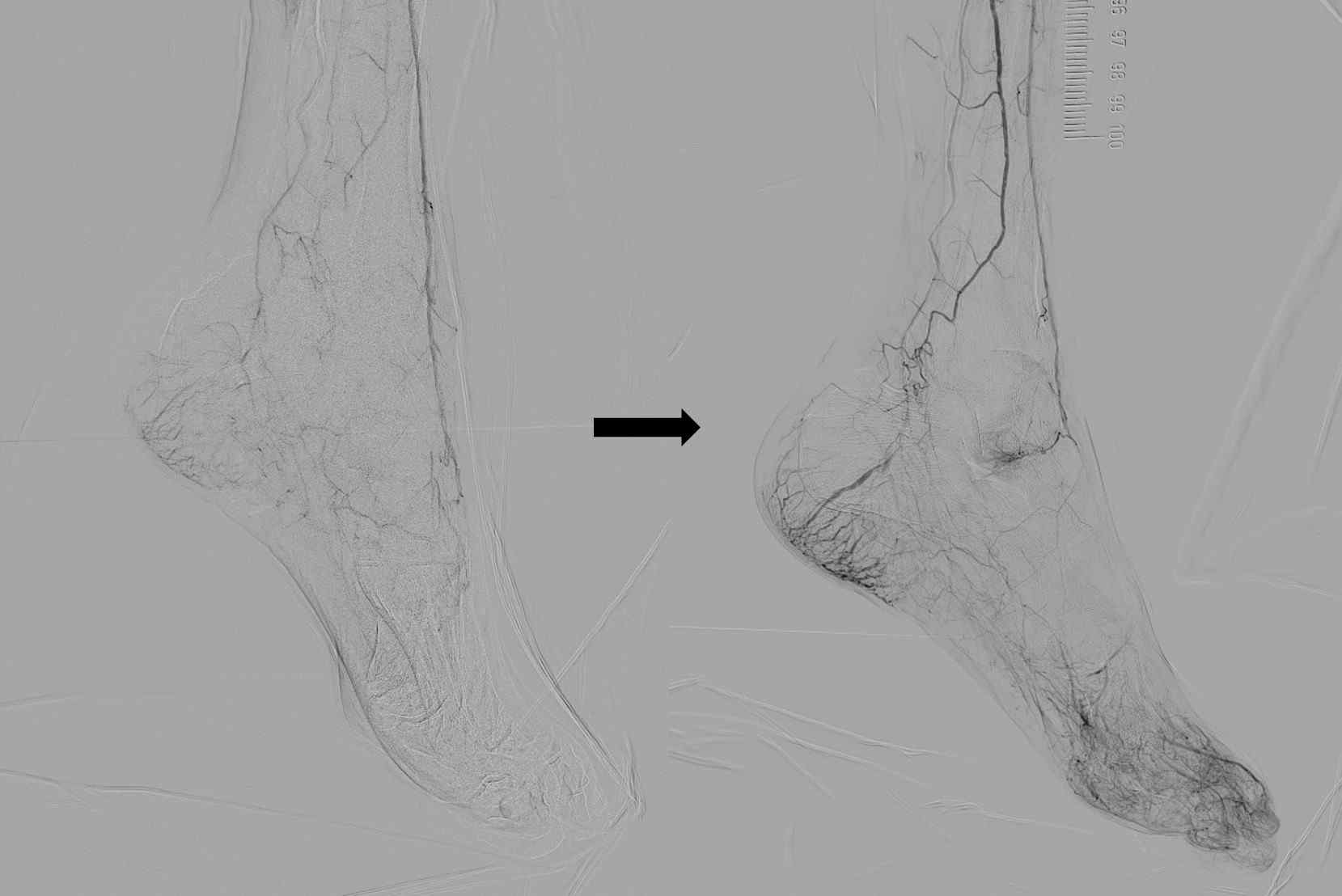 시술 전후 측부 미세 혈관의 생성을 보여주는 혈관 조영술 영상