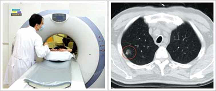 흉부 CT 촬영 및 흉부 CT 내 발견된 폐결절