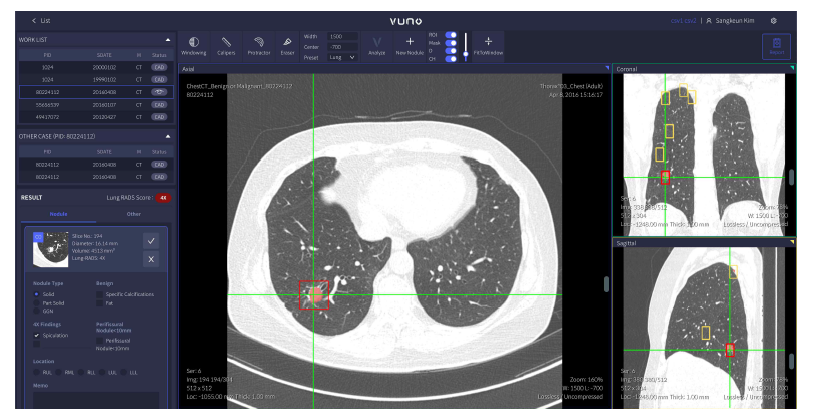 폐결절 검출 결과의 사용자 인터페이스 화면 출력