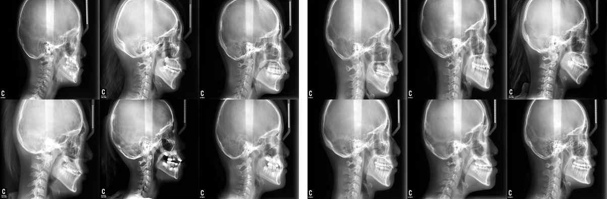 PGGAN을 이용한 고해상도 lateral cephalometric X-ray 영상 생성 (왼쪽) 실제 영상 (오른쪽) 생성된 영상