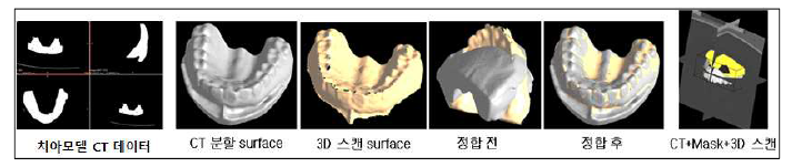 Dental CT 영상(상악치아)과 3D 스캔영상의 정합: Dental 영역, 0.8mm 정합 정확도 결과