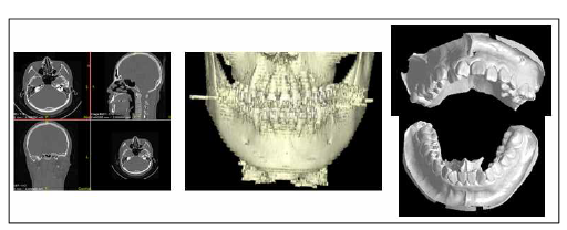 CBCT 영상의 경조직(치아포함) 분할 및 3D 스캔 모델(오른쪽)