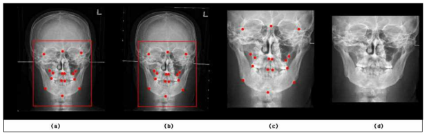 Frontal 영상 전처리 과정. (a) 원본 영상, (b) Fronto Zygomatic suture right & left 기준으로 rotation, (c) (b)를 기준으로 crop한 영상, (d) resize한 영상