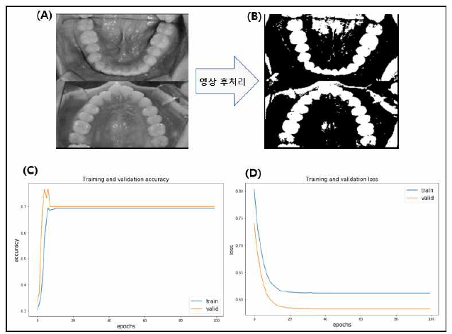 교정치료를 위한 환자의 발치 필요 여부 예측 알고리즘 개발에 사용한 영상(A, B) 및 학습 결과(C, D)