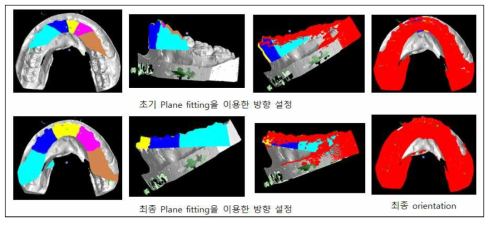 3차원 치아 모델 방향 자동 설정의 예