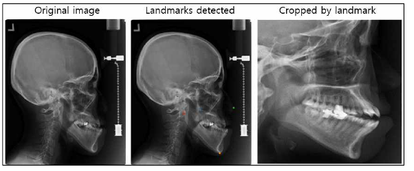 왼쪽부터 Lateral cephalometry 원본 영상, cropping을 위한 4개의 랜드마크가 추출된 영상, 랜드마크를 기준으로 사각형 Cropping된 영상. 가장 오른쪽 영상이 학습에 입력으로 사용됨