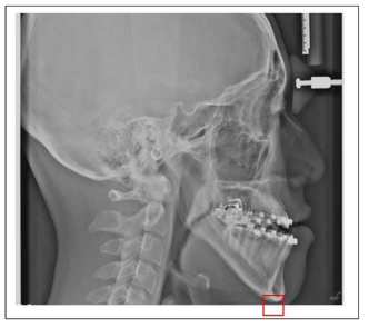 Soft tissue menton 부분이 영상에 제대로 표현되지 않는 경우의 예제