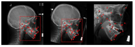 데이터 표준화 전처리 기술 개발: (왼쪽) 원본, (가운데) Sella-Nasion 기분 영상 회전, (오른쪽) landmark 주변 영역으로 한정하여 영상 Cropping