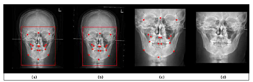 Frontal 영상 전처리 과정. (a) 원본 영상, (b) Fronto Zygomatic suture right & left 기준으로 rotation, (c) (b)를 기준으로 Crop한 영상, (d) Resize한 영상