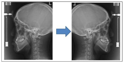 Flip된 Cephalometric 영상 및 수정 후 영상