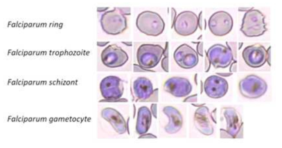 당사가 개발한 랩온어칩에 탑재하여 혈액도말 슬라이드를 제작한 후 인공지능 모바일 말라리아 진단시스템을 통해 확인한 falciparum 의 대표 형태학적 이미지. 위에서부터 ring, trophozoites, schizonts, gametocytes