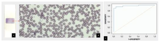 랩온어칩 활용한 혈액 슬라이드 자동화 제작 결과 (A) 및 자동 이미지 결과 (B). 인공지능 알고리즘의 ROC (Receiver Operating Characteristic curve)를 통한 민감도 및 특이도 변화
