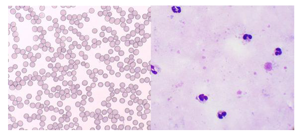 음성환자의 결과 (miLab™ slide vs. Giemsa thick smear)