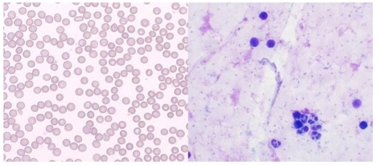 양성환자의 결과 (miLab™ slide vs. Giemsa thick smear)