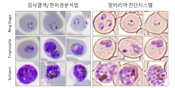 배양된 말라리아 원충이미지. 김사염색기반 현미경분석법을 통한 이미지 (좌) 및 랩온어칩 활용한 인공지능 말라리아 진단시스템을 통한 이미지 (우)