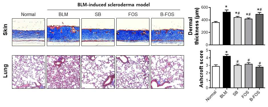 BLM scleroderma model에서 B-FOS에 대한 피부경화증 억제 효과 검증. *P < 0.05 vs Normal, #P < 0.05 vs BLM