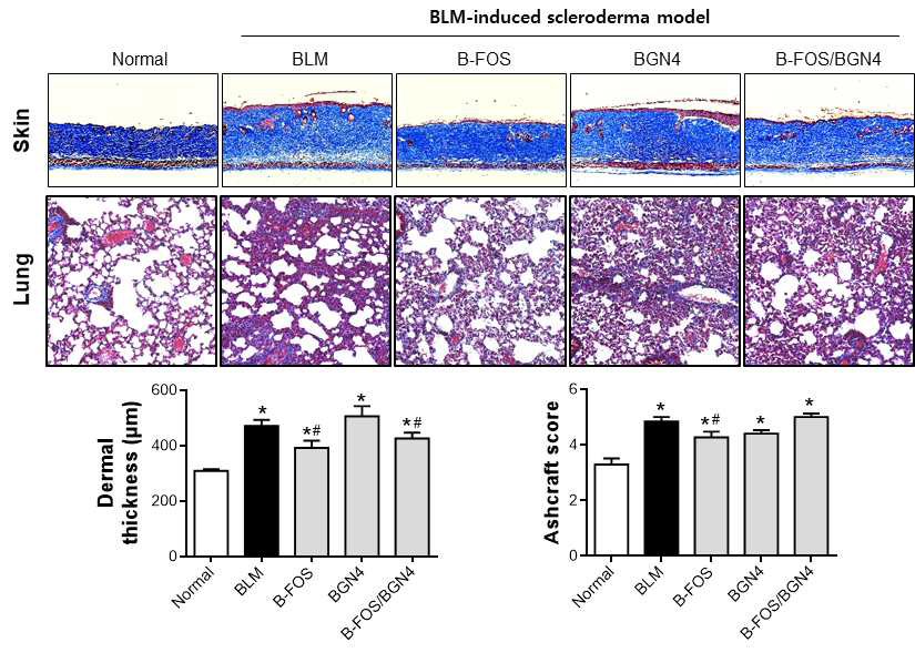 BLM scleroderma model에서 B-FOS/BGN4에 대한 피부경화증 억제 효과 검증. *P < 0.05 vs Normal, #P < 0.05 vs BLM