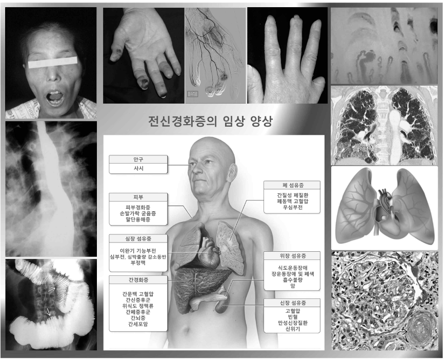 전신경화증의 임상소견 및 주요증례