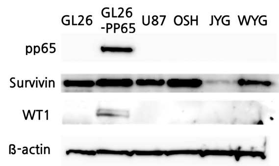 교모세포종 환자 조직에서 CMV 삼중항원 발현 확인 (Western blot)