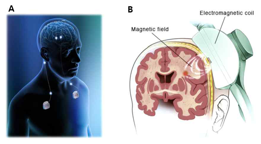 (A)뇌심부자극술 (B)경두개 자기자극 장치