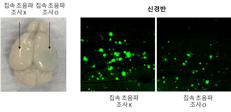 집속 초음파 단일 조사에 의한 알츠하이머병 동물모델 뇌 내 신경반 감소