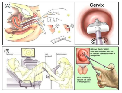 자궁경부암 검사. (A) 자궁경부 세포 검사 (Pap test)와 인유두종 바이러스 검사 (HPV test), (B) 질확대경 검사 (Colposcopy)와 조직 검사 (Punch biopsy)