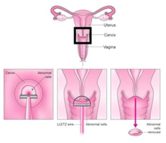 자궁경부 전암병변에 대한 원추절제술