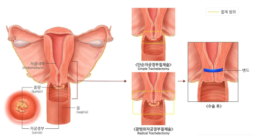 자궁 경부 광범위 절제술