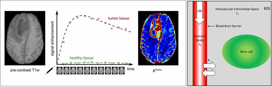 뇌종양에서의 DCE-MRI 영상 예시 및 BBB 투과도 지표 계산 시 compartment model 예시. 조영제(contrast)가 plasma에서 EES(extravascular extracelluar space)로 새어 나가는(extra-vasation) 현상을 이용해서 permeability의 국소적 변화(regional change)를 정량화해서 평가하는 방법임 (Heye et al., 2014; Chakraborty et al., 2017)