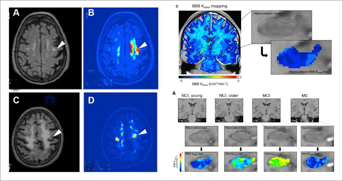 (좌측) small vessel disease에 적용한 DCE-MRI 영상 예시 및 (우측) 정상 및 경도인지장애군에서의 DCE-MRI촬영 후 획득된 hippocampus 영역 BBB 투과도 지표 매핑 예시 (Taheri et al., 2011; Montagne et al., 2015)