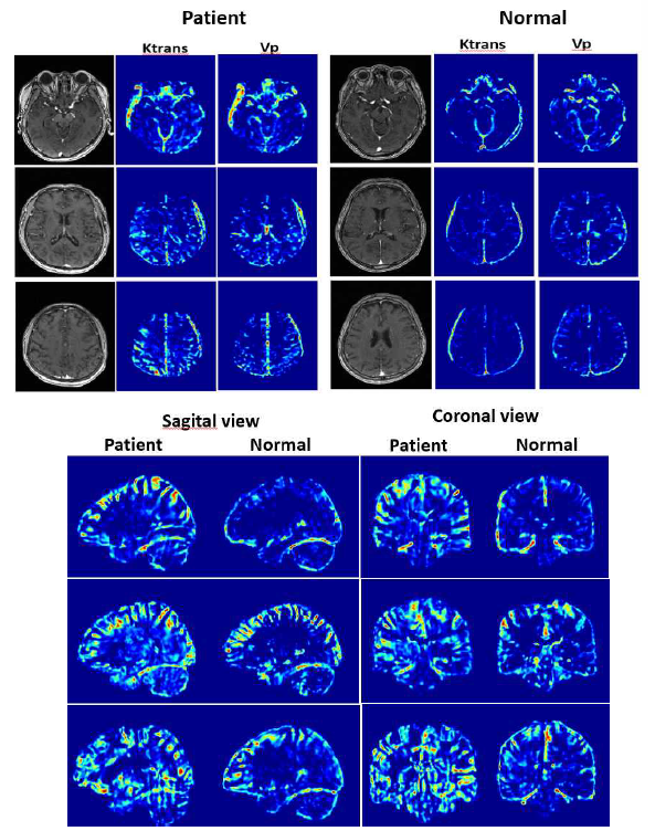 뇌혈관계 투과도 Ktrans의 환자군과 정상 비교