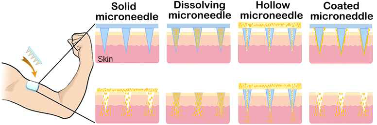 마이크로니들 종류에 따른 백신 전달 방법