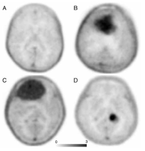 뇌종양 환자들의 뇌부위 [18F]FMT PET 영상 ※ 이 연구결과는 Moon, et al. “Clinical usefulness of 18F-FC119S PET as an auxillary diagnostic method for dementia: an open-label, single-dose, evaluator-blind, clinical trial”Clin Nucl Med (2021)46:9. 에 보고되었음 (IF = 7.79)