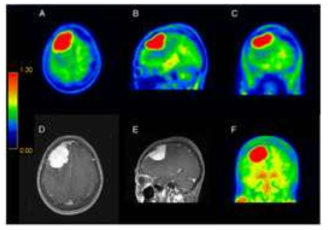 76세 여성. 경도인지장애로 [18F]Florapronol PET을 촬영하였고, 높은 섭취 보이는 병소는 MRI 및 추가적인 수술적 절제 후 뇌수막종으로 확인됨 ※ 이 증례보고는 Lee, et al. “Incidental 18F-Florapronol Uptake in Meningioma”Clin Nucl Med (2021)46:8. 에 게재됨 (IF = 7.79)