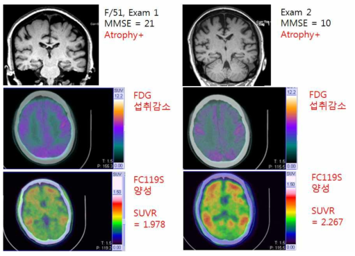 경도인지장애 환자에서 2년 간격으로 촬영한 PET과 MRI소견