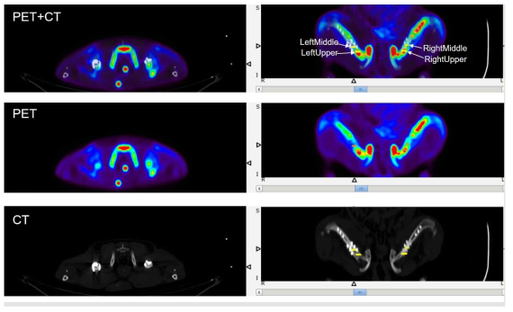 관심영역 설정을 위한 PET, CT, 그리고 PET/CT융합영상. PET영상은 주사 30분 후 영상임