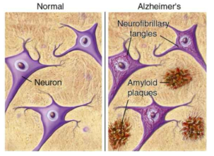 알츠하이머 치매에서 신경손상