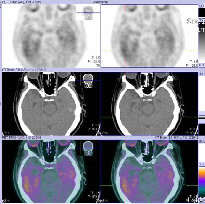 한국원자력의학원에서 촬영한 18F-AV-1451 PET 영상. 76세 여성, 혈관성 치매환자