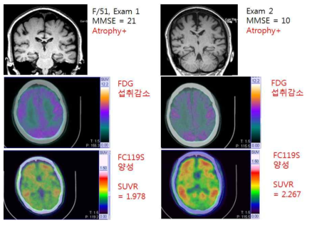 경도인지장애 환자에서 2년 간격으로 촬영한 PET과 MRI소견>