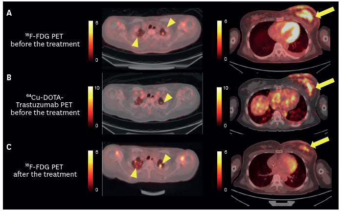 45세 여성. 유방암의 폐전이 상태에서 치료 전후 [18F]FDG PET (A, C)과 치료 전 [64Cu]DOTA-trastuzumab PET (B) 촬영함. [64Cu]DOTA-trastuzumab PET에서 높은 섭취 보인 유방암은 치료 반응이 좋았으나, 낮은 섭취 보인 폐전이는 치료에 반응 보이지 않았음