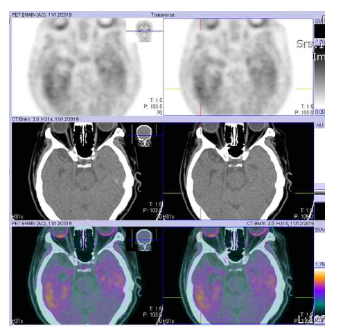 한국원자력의학원에서 촬영한 18F-AV-1451 PET 영상. 76세 여성, 혈관성 치매환자