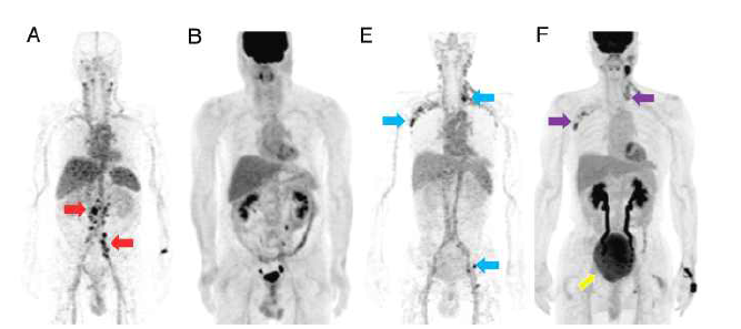 64Cu-DOTA-rituximab PET영상