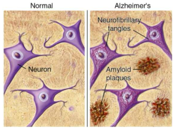 알츠하이머 치매에서 신경손상