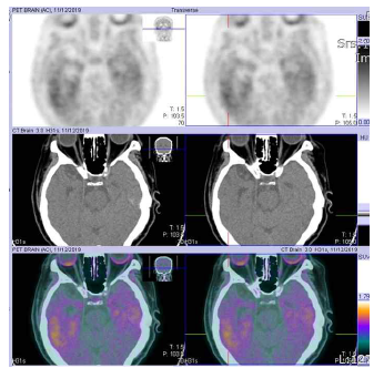 한국원자력의학원에서 촬영한 18F-AV-1451 PET 영상. 76세 여성, 혈관성 치매환자