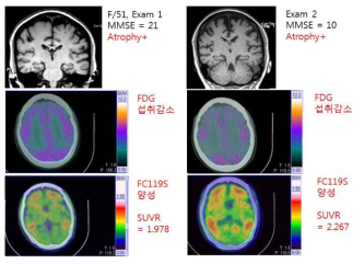 경도인지장애 환자에서 2년 간격으로 촬영한 PET과 MRI소견