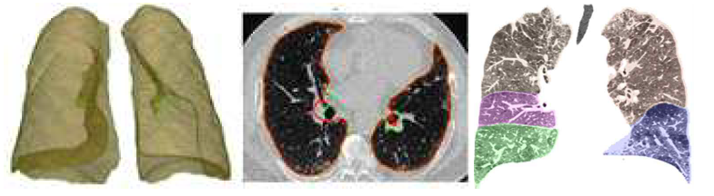분할된 폐의 3차원 모습(좌), 2차원 슬라이스에서의 폐 영역 분할(중), 정면에서 본 폐엽 분할 결과(우)