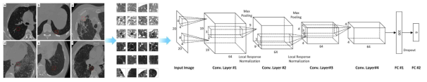 CT영상에서 소견이 존재하는 관심영역을 뽑아서 합성곱신경망에 입력