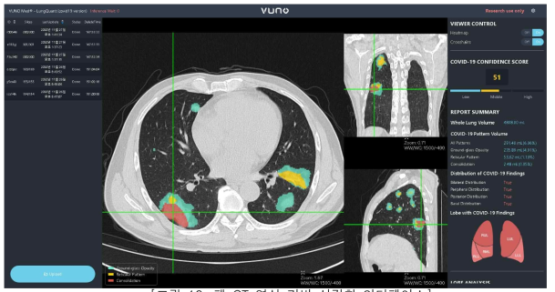 폐 CT 영상 기반 시각화 인터페이스