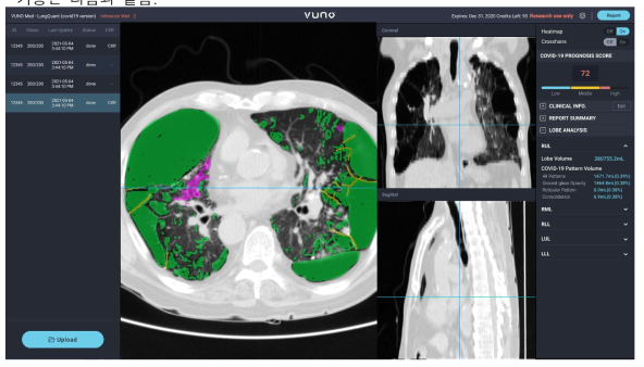 5가지 소견 탐지 폐CT 기반 호흡기 감염병 진단용 인공지능 폐분석 SW 제품 UI